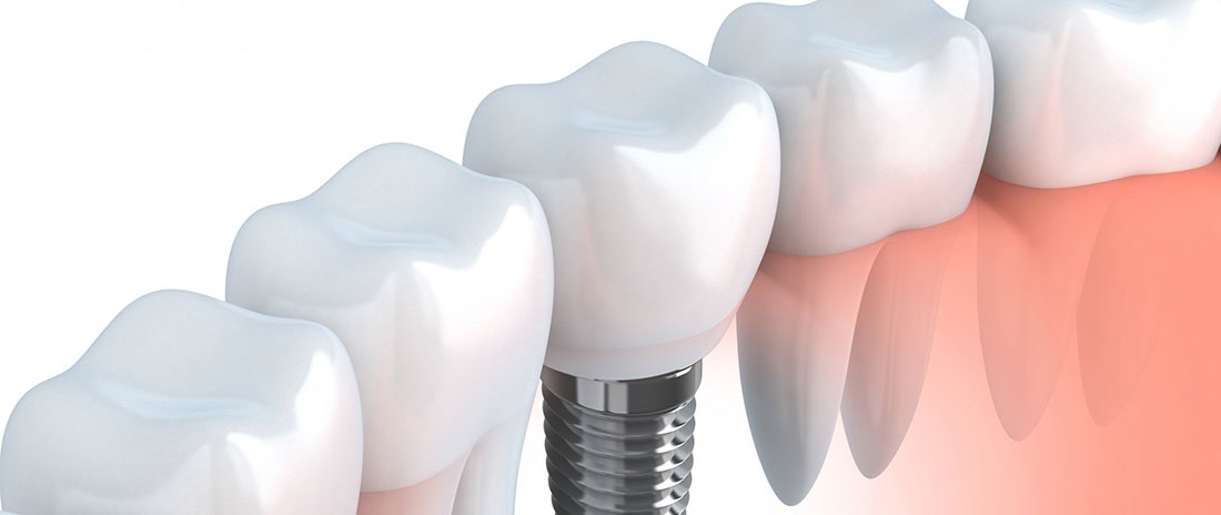 Ataşehir İmplant | İmplant Tedavisi